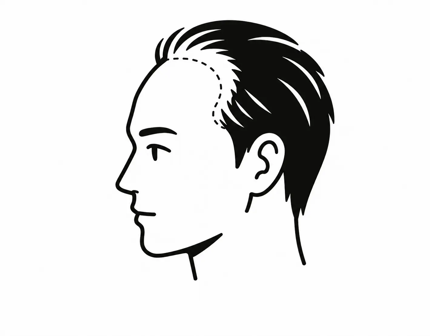 生え際の後退